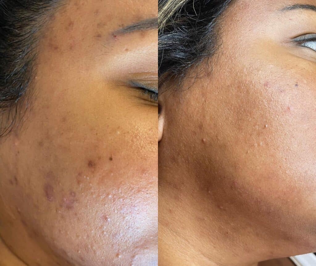 Microneedling treatment at Belle Ame Skin and Beauty Lounge in Vancouver