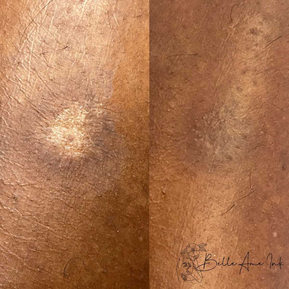 Scar Camouflage Tattoos at Belle Ame Skin and Beauty Lounge in Vancouver