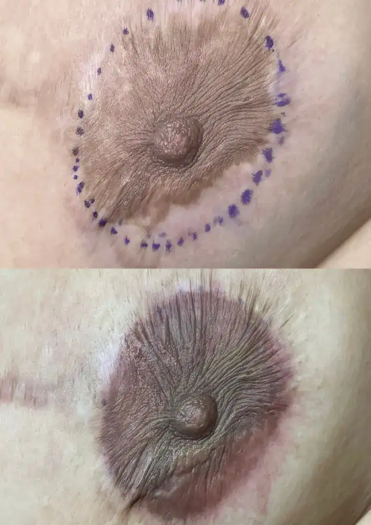 Areola Tattoos at Belle Ame Skin and Beauty Lounge in Vancouver