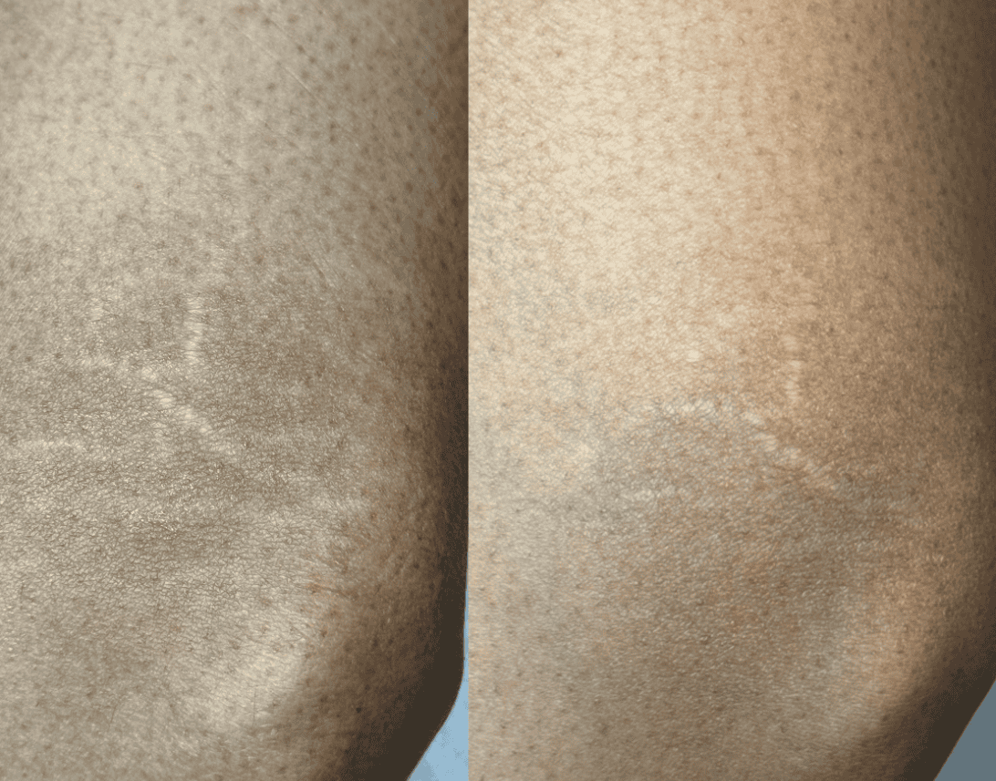 inkless campuflage for stretch marks and scars at belle ame ink