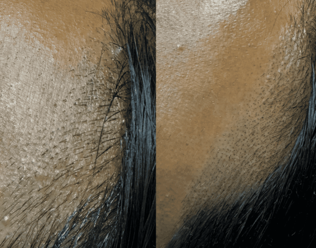 Scalp Micropigmentation (SMP) at Belle Ame Skin and Beauty Lounge in Vancouver