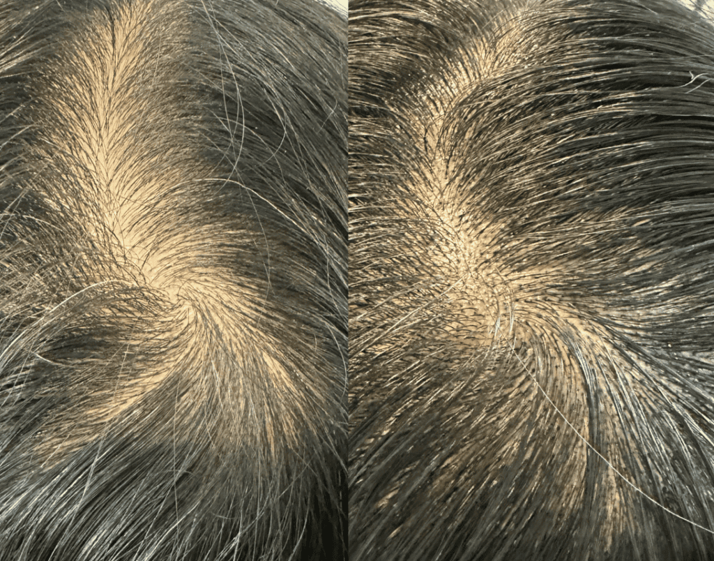 Scalp Micropigmentation (SMP) at Belle Ame Skin and Beauty Lounge in Vancouver