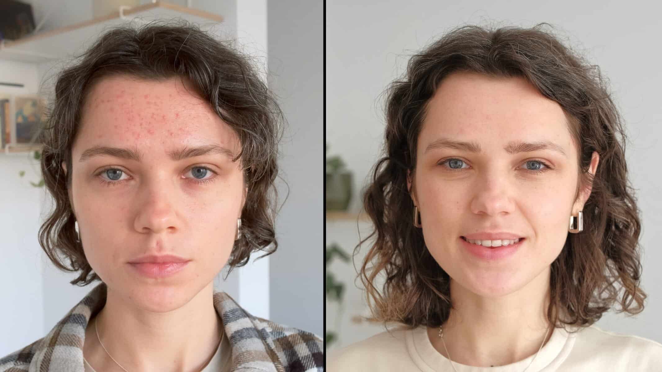 Woman with acne-prone skin before and after microneedling treatment at Belle Ame Skin & Beauty in Vancouver.