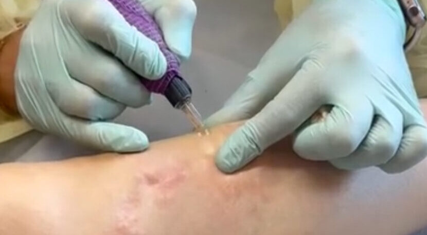 Professional pigment camouflage tattoos procedure on scarred skin, demonstrating advanced training techniques for skin tone correction and scar concealment.