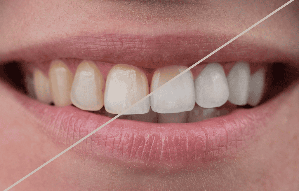 Porcelain dental veneers whitening cosmetic dentistry for a bright, flawless smile.