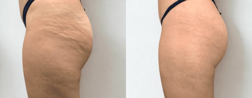 Close-up of skin showing improved texture after inkless camouflage revision treatment