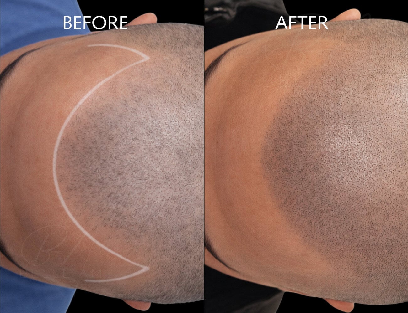 Scalp micropigmentation SMP vancouver Belle ame skin and beauty lounge about