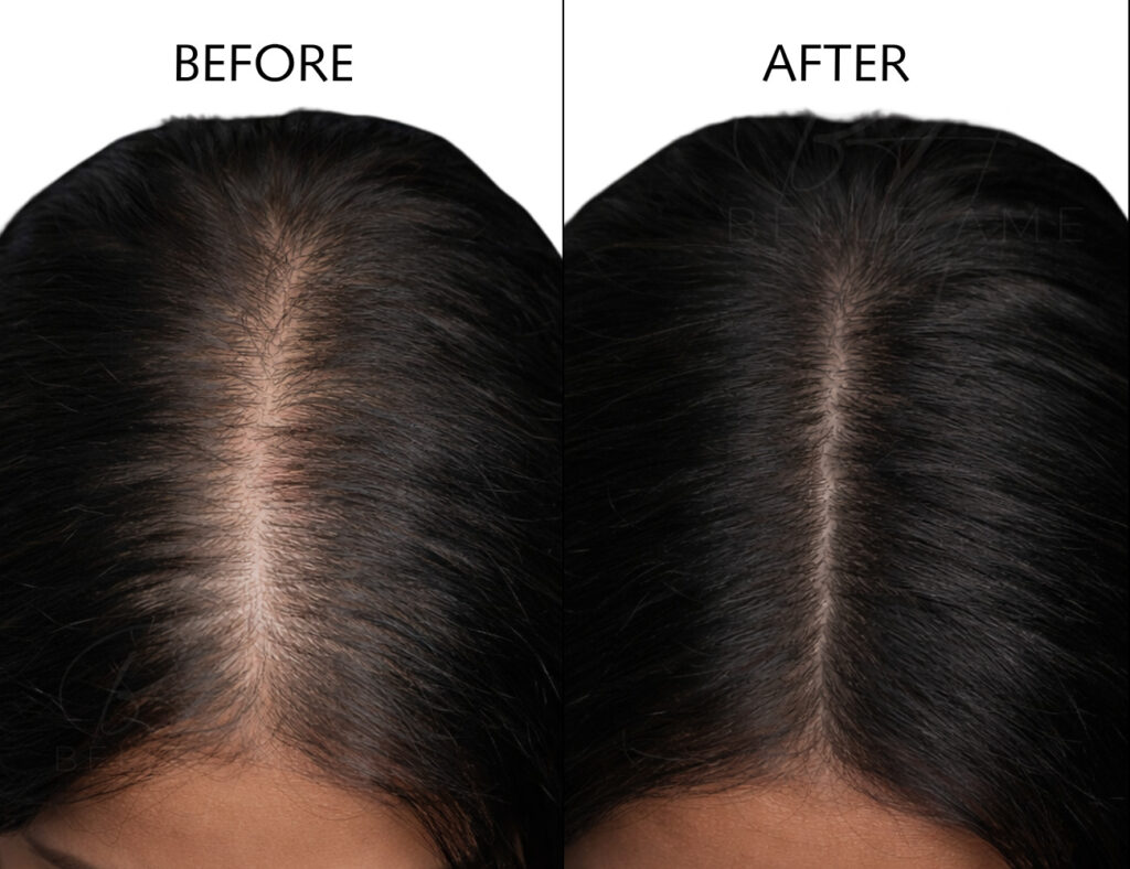 SMP Hair Loss Vancouver Belle ame skin and beauty lounge about