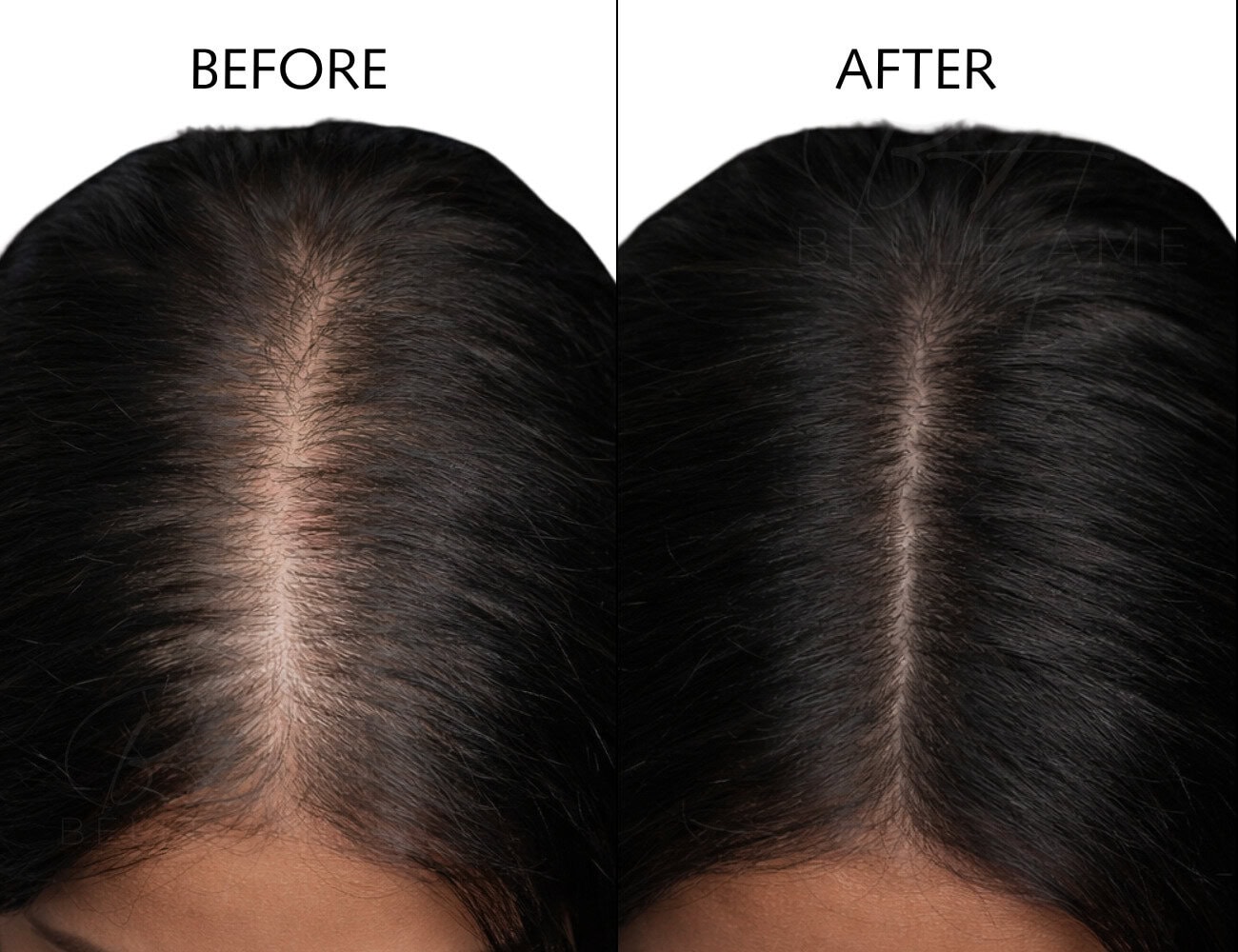 SMP Hair Loss Vancouver: 3 Proven Hair Options