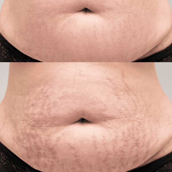 Inkless camouflage treatment in Vancouver