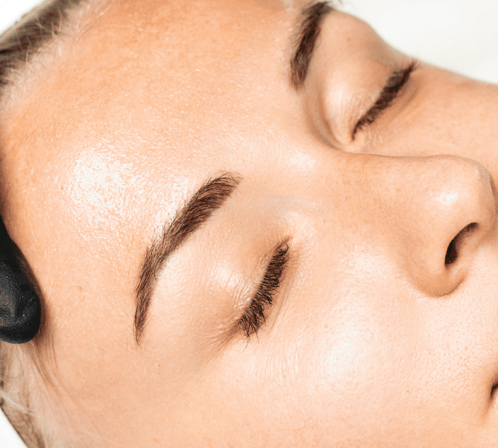 Microneedling treatment in Vancouver