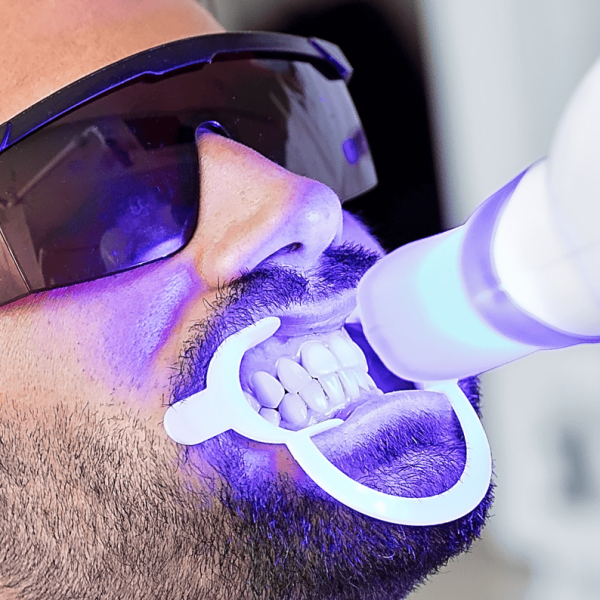 Professional teeth whitening in Vancouver