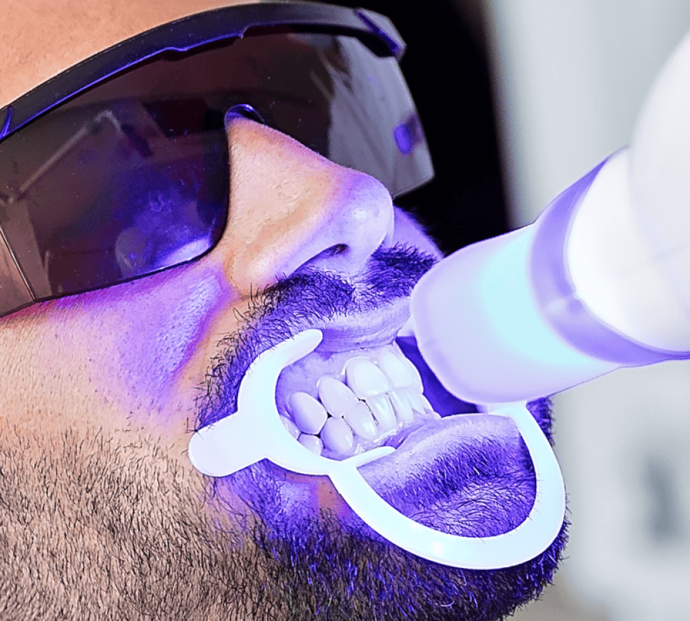 Professional teeth whitening in Vancouver