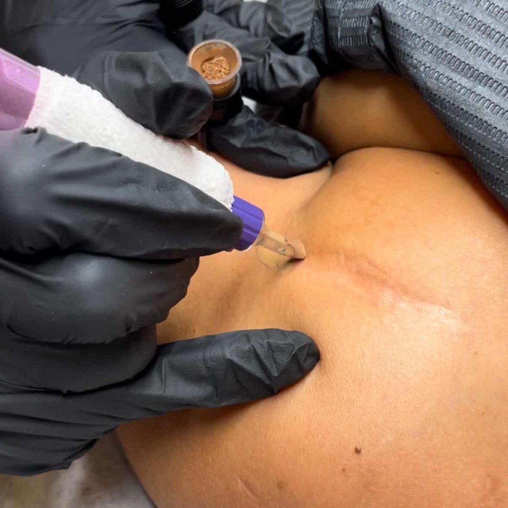 Scar Camouflage Tattoo at Belle Ame Skin and Beauty Lounge in Vancouver